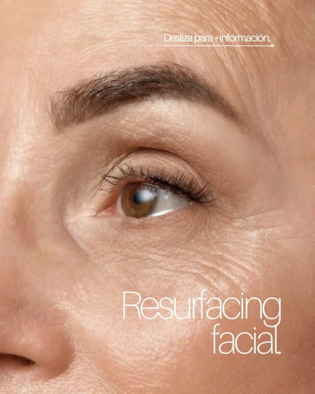 ¡Lifting sin cirugía! ✨ El resurfacing elimina arrugas, manchas y cicatrices 💥 Regenera la piel desde dentro, estimula colágeno y devuelve firmeza, luz y suavidad 💫 ¡Renace de forma natural! 🌿 

#belleza #salud #inmamanrique #oropesadelmar #tratamientofacial